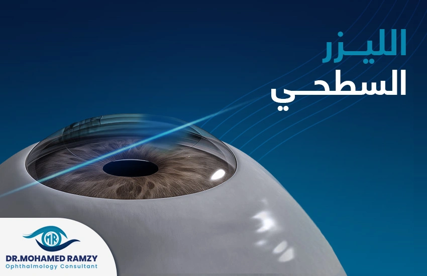 الليزر السطحي