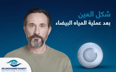 شكل العين بعد عملية المياه البيضاء