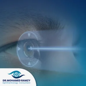 انواع الليزر السطحي